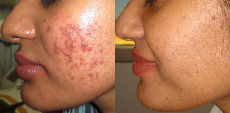 Acne Treatment — before treatment