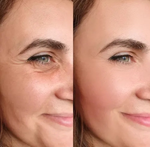 Botox Treatment — before treatment